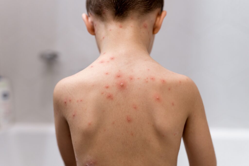 Child with chickenpox
