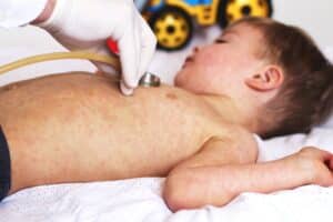 Baby with a widespread measles rash across the chest and back
